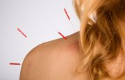 Acupuncture for Osteoporosis