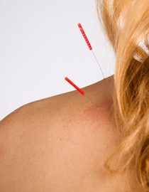 Acupuncture for Osteoporosis Acupuncture for Osteoporosis