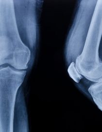 Testing for Osteoporosis Testing for Osteoporosis