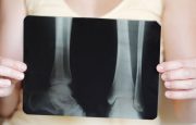 Osteoporosis Symptoms