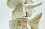 Osteoporosis Risk Factors